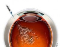 Oční klinika NeoVize, biologická léčba Avastinem