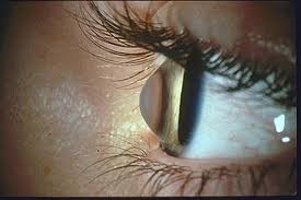 Oční klinika NeoVize, onemocnění keratokonus